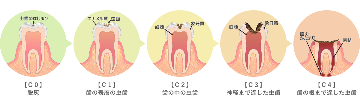 虫歯の進行