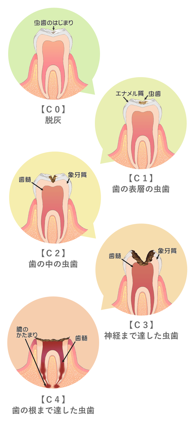 虫歯の進行