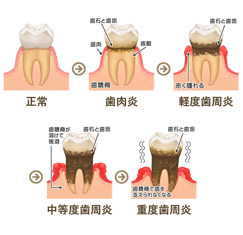 歯周病治療