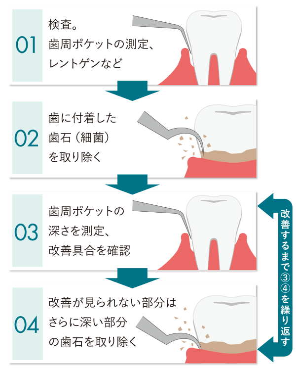 歯周病治療の流れ