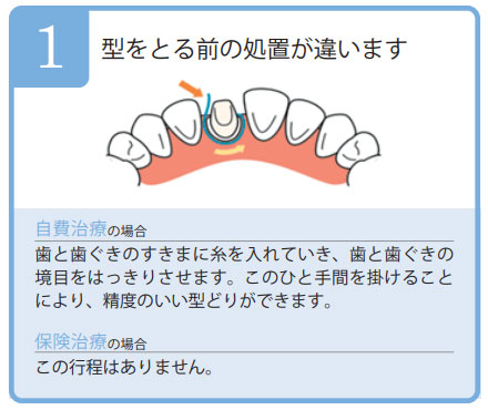 型をとる前の処置