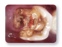 虫歯の再発