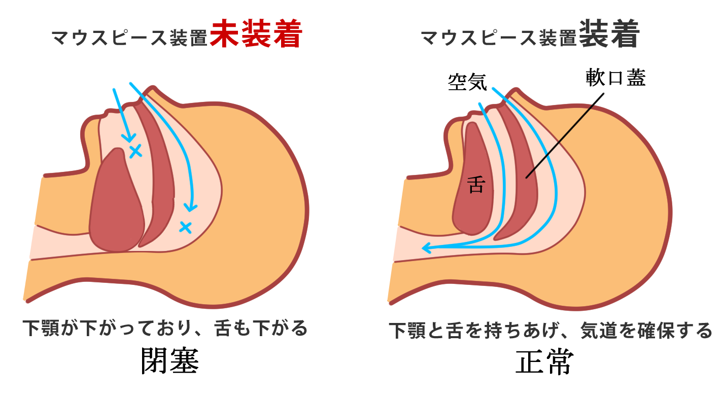 睡眠時無呼吸低呼吸症候群